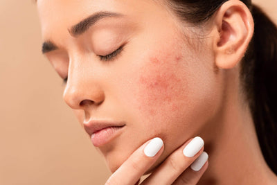 How to get rid of acne scars？