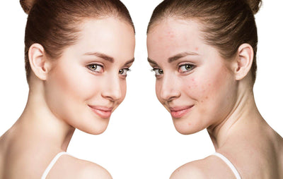 What is the best way to prevent a horrible acne breakout?
