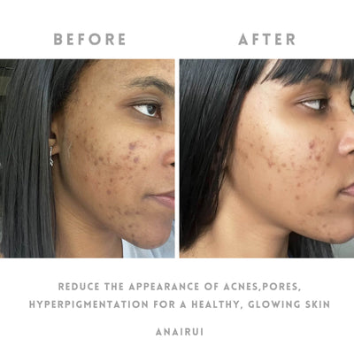 ANAIRUI Natürliche Kurkuma-Tonerde-Gesichtsmaske für zu Akne neigende Haut, Aufhellende Hautmaske 120 g